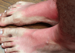 get relief from burning and tingling feet at naperville neuropathy clinic
