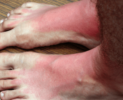 get relief from burning and tingling feet at naperville neuropathy clinic