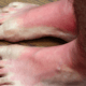 get relief from burning and tingling feet at naperville neuropathy clinic